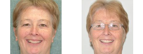 Invisalign