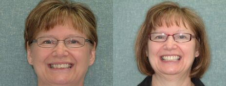 Invisalign