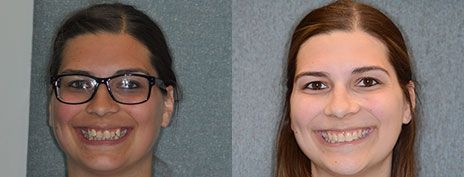 Invisalign
