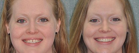 Invisalign